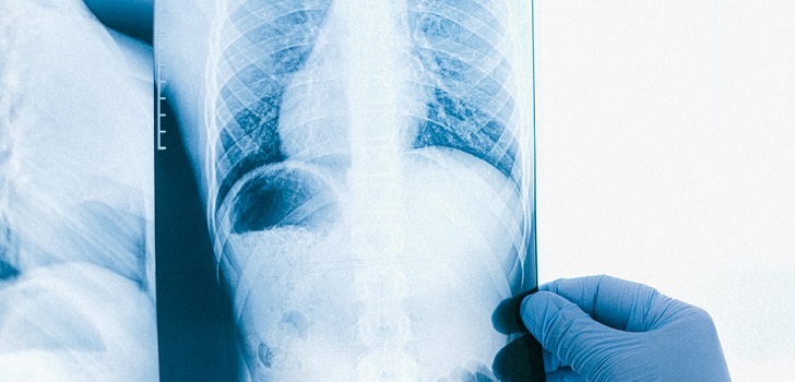 Radiografía Unilabs contrata a Qure.ai para clasificar las radiografías de tórax