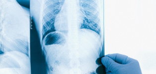 Unilabs contrata a Qure.ai para clasificar las radiografías de tórax